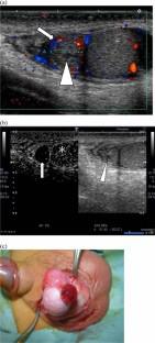 Contrast-enhanced ultrasonographic findings in torsion of the appendix testis or epididymis in children: a case series.