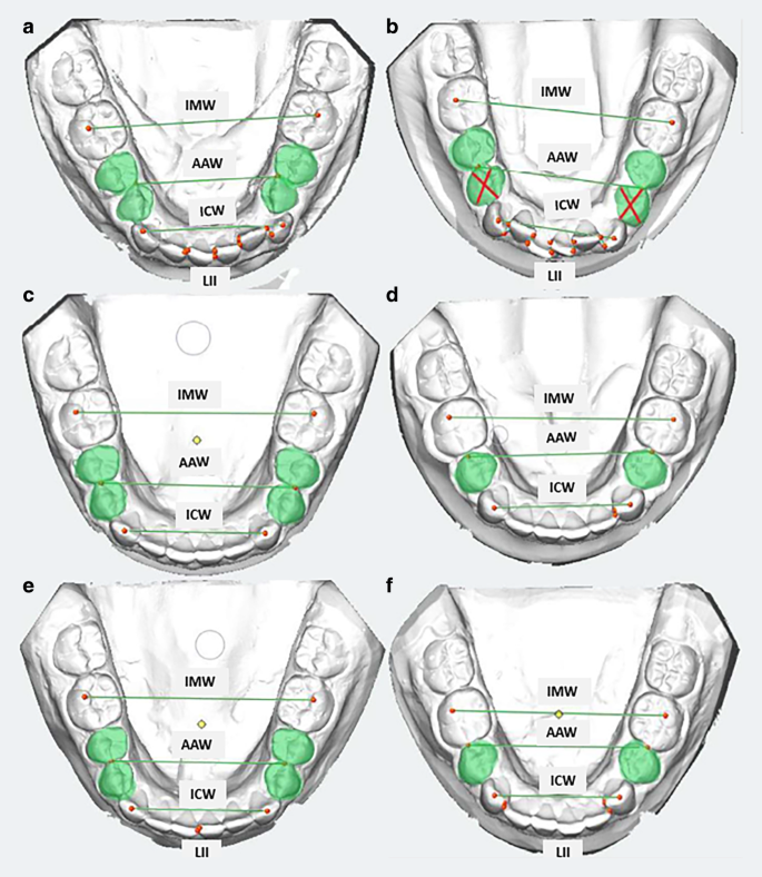 Posttreatment stability following therapy using passive self-ligating brackets: extraction vs. nonextraction.