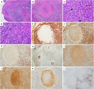 The lymph node in IgA vasculitis (Henöch-Schonlein purpura).