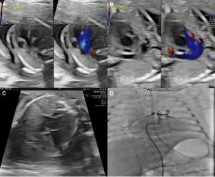 Dichorionic Diamniotic Twin Pairs with Complex Congenital Heart Disease.