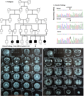 A novel nonsense variant in EXOC8 underlies a neurodevelopmental disorder