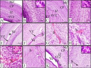 Edaravone Confers Neuroprotective, Anti-inflammatory, and Antioxidant Effects on the Fetal Brain of a Placental-ischemia Mouse Model.