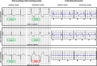 Simultaneous subcutaneous implantable cardioverter-defibrillator and leadless pacemaker implantation for patients at high risk of infection: a retrospective case series report.