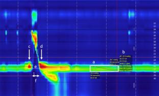 The Manometric Representation of the Upper Esophageal Sphincter During the Resting State: A Descriptive Study.