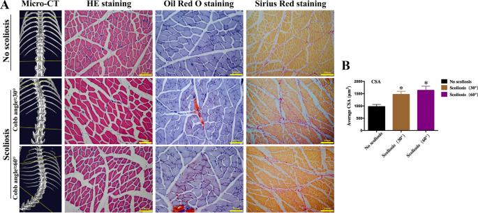 Bioinformatics analysis of paravertebral muscles atrophy in adult degenerative scoliosis.