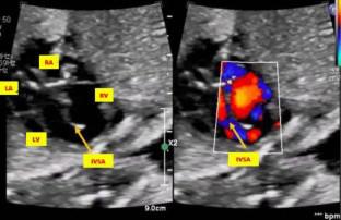 Prenatally Diagnosed Interventricular Septal Aneurysm with Associated Ventricular Dysfunction.