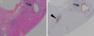 A novel pathologic marker, indoleamine 2,3-dioxygenase 1, for the cholangiopathy of immune checkpoint inhibitors-induced immune mediated hepatotoxicity as adverse events and the prediction of additional ursodeoxycholic acid treatment.