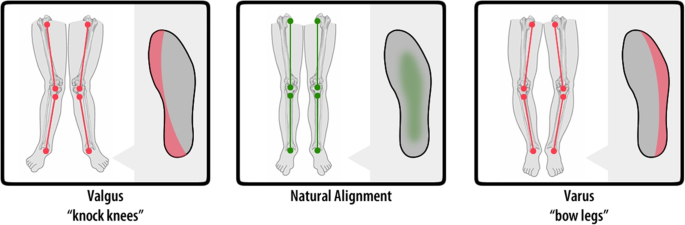 Auditory feedback in tele-rehabilitation based on automated gait classification