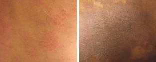 Atopic Dermatitis Across Shades of Skin