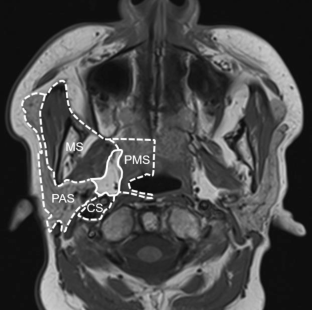 Primary Pathology of the Parapharyngeal Space.