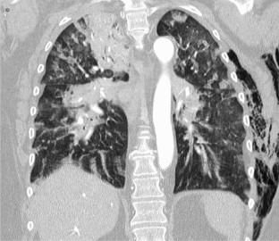 Veno-arterial-venous extracorporal membrane oxygenation (V-AV ECMO) in a patient in ARDS and cardiac instability after severe polytrauma.