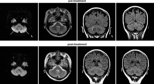 Acute cerebellitis following COVID-19 infection associated with autoantibodies to glutamate receptors: a case report.