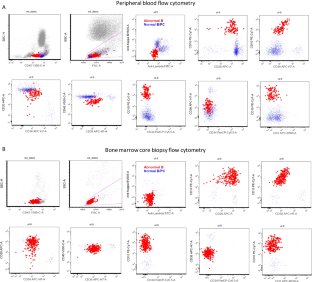 B-lymphoblastic leukemia with transient spontaneous remission in the setting of severe group A streptococcus infection