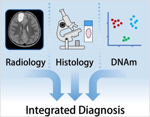 DNA methylation-based classification of glioneuronal tumours synergises with histology and radiology to refine accurate molecular stratification.