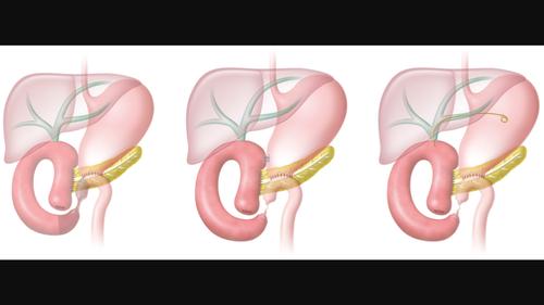 Early and late effects of endoscopic interventions in patients with malignant afferent loop syndrome: A single-center experience and literature review