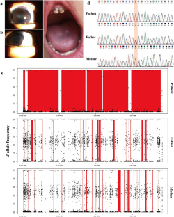 Functional Characterization of a Novel SLC4A4 Variant and Uniparental Isodisomy in Proximal Renal Tubular Acidosis Patient.