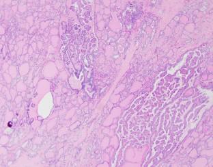 Thyroid Nodules and Follicular Cell-Derived Thyroid Carcinomas in Children.