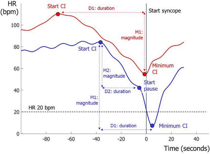 Variability of cardioinhibition in vasovagal syncope: differences between subgroups during cardioinhibition and beyond.