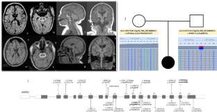 Delineating the phenotype and genetic basis of AMPD2-related pontocerebellar hypoplasia.