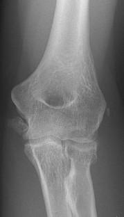 Ulnar nerve neuropathy caused by pathologic ossification: a case report.