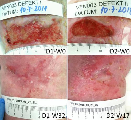 Cryopreserved amniotic membrane in chronic nonhealing wounds: a series of case reports.