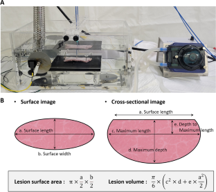 The effect of half-normal saline irrigation on lesion characteristics in temperature-flow-controlled ablation.