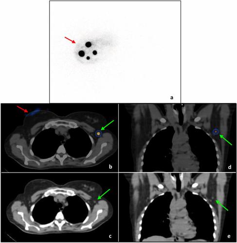 Detailed preoperative lymphatic mapping by lymphoscintigraphy for sentinel node identification: a pictorial essay