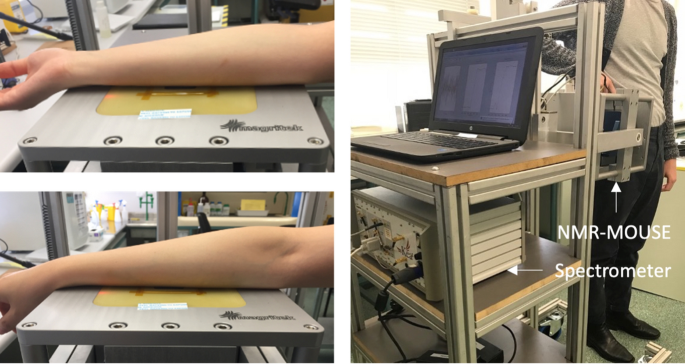 Single-Sided Nuclear Magnetic Resonance (NMR) for the Analysis of Skin Thickness and Collagen Structure in Scarred and Healthy Skin