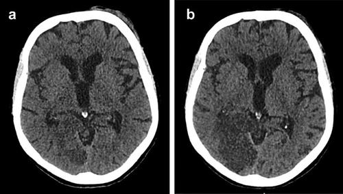 Cerebrovascular Manifestations of SARS-CoV-2: A Comprehensive Review.