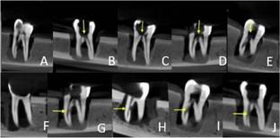 Assessment of the diagnostic accuracy of strip and furcal perforations in different sizes by cone beam computed tomography.