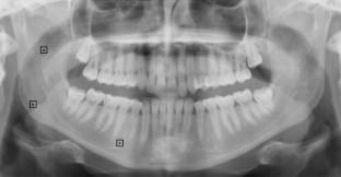 Evaluation of the effect of antiepileptic drugs on mandibular bone quality by fractal analysis.