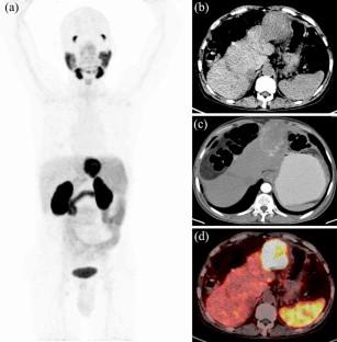 A prospective study of <sup>68</sup>Ga-PSMA PET/CT imaging of HCC as diagnosed on conventional imaging to evaluate for potential <sup>177</sup>Lu-PSMA therapy.