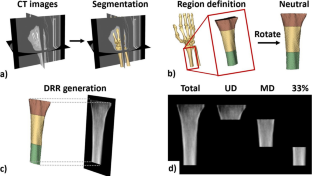 The effect of forearm rotation on the bone mineral density measurements of the distal radius.