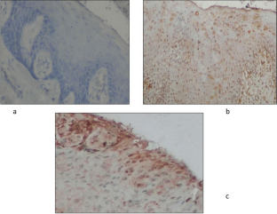 Expression of NLRP3 and superoxide dismutase-2 (SOD2) in the gingival tissues of periodontitis patients with and without type 2 diabetes mellitus: a case–control study