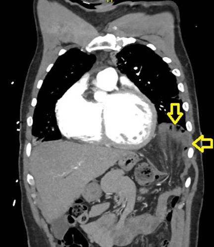 Thoracoabdominal approach for traumatic diaphragmatic hernia in a hemodynamically unstable patient.