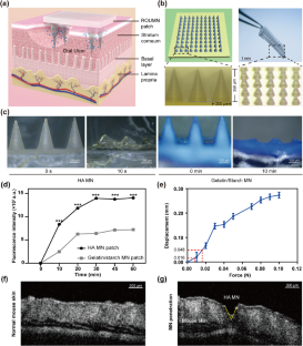 Multidrug dissolvable microneedle patch for the treatment of recurrent oral ulcer