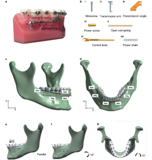 Total mesialization of the mandibular dentition using a mini-implant-supported device : A finite element analysis.