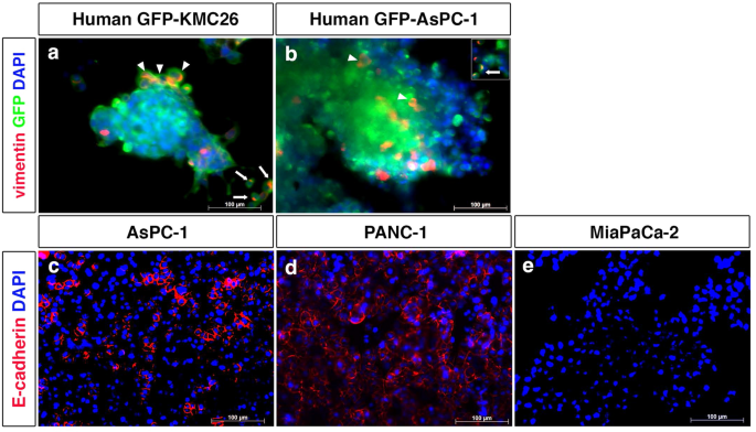 Pancreatic cancer cell-derived exosomes induce epithelial-mesenchymal transition in human pancreatic cancer cells themselves partially via transforming growth factor β1.