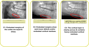 Assessing quality and quantity of cortical bone in childhood cancer survivors using anthropometric indices.