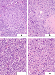 EBV-positive follicular lymphoma and concurrent EBV-negative diffuse large B-cell lymphoma illustrating branched evolution model and “Hit and Run” hypothesis