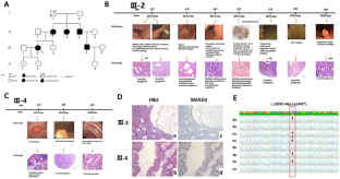 Clinical and functional characterisation of the SMAD4 germline variant c.1035C > A in a family with juvenile polyposis syndrome by whole-exome sequencing.