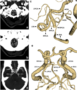 Bilateral duplicated hypoplastic superior cerebellar arteries one of which originates from a full-type fetal posterior cerebral artery.