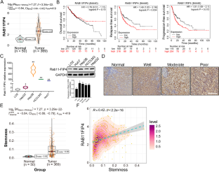 Rab11-FIP4 interacts with ARF5 to promote cancer stemness in hepatocellular carcinoma.