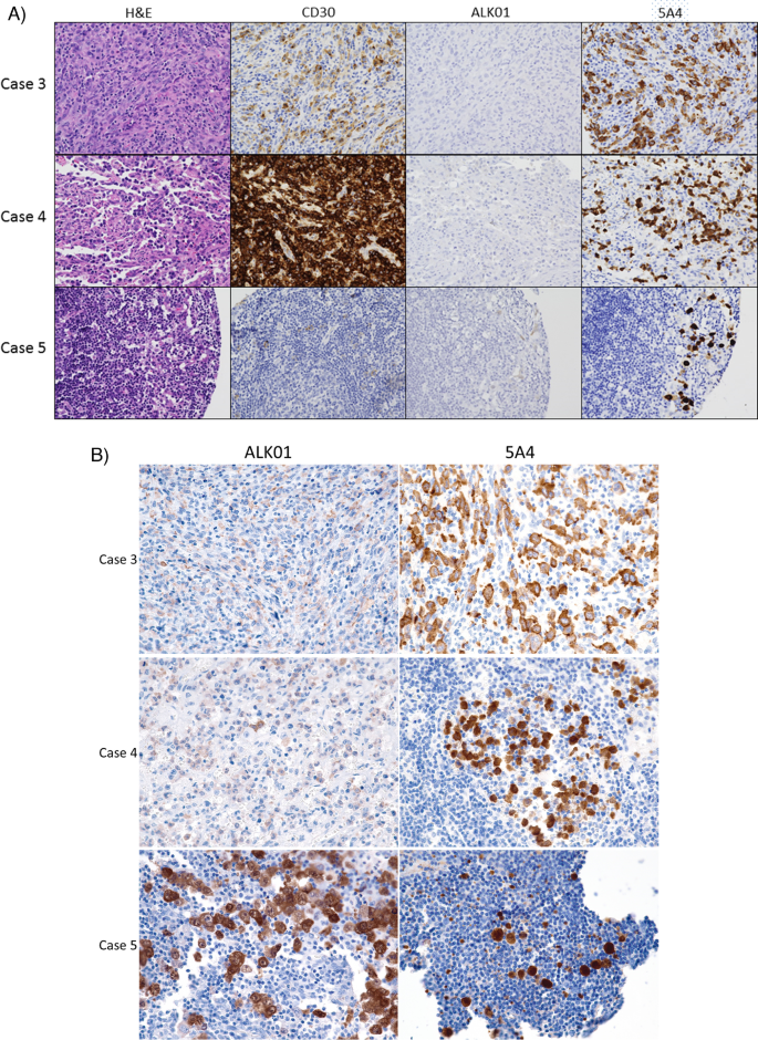 Comparison of two immunohistochemical staining protocols for ALK demonstrates non-inferiority of a 5A4 clone-based protocol versus an ALK01 clone-based protocol for the diagnosis of ALK + anaplastic large cell lymphoma.