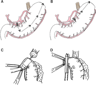 Comparison of the subtotal and narrow gastric conduit for cervical esophagogastrostomy after esophagectomy in esophageal cancer patients: a propensity score-matched analysis.