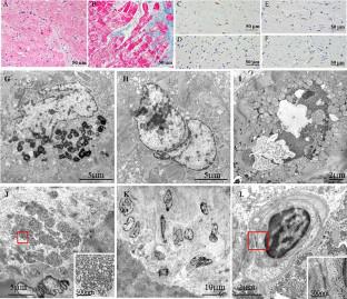 Pathological features of biopsied myocardium in patients clinically diagnosed with peripartum cardiomyopathy.