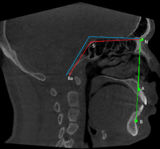 Evaluation and comparison of planum clival angle in three malocclusion groups : A CBCT study.