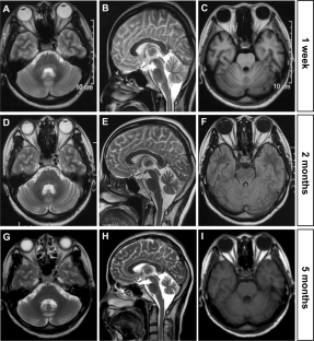 Favorable Outcomes in a Case of Non-paraneoplastic DNER Ataxia Treated with Immunotherapy.