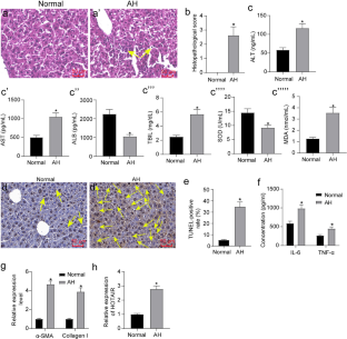 Long non-coding RNA HOX transcript antisense intergenic RNA depletion protects against alcoholic hepatitis through the microRNA-148a-3p/sphingosine 1-phosphate receptor 1 axis.