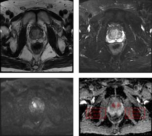 Management Strategy for Prostate Imaging Reporting and Data System Category 3 Lesions.